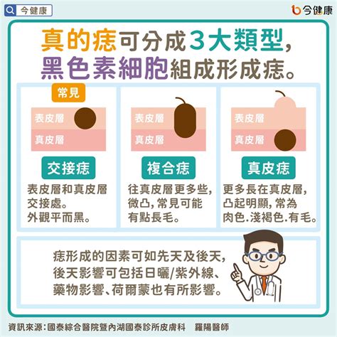 身體痣|痣是什麼？一次了解痣原因、就醫時機以及如何改善